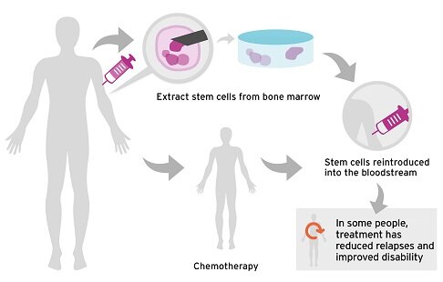 Can Stem Cell Therapy Cure Multiple Sclerosis?